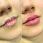 Preenchimento labial